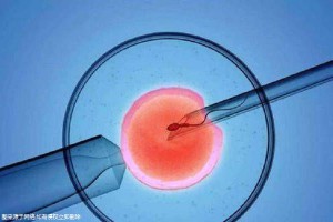 第三代试管婴儿